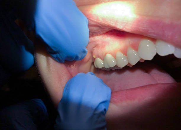 Best Broken Tooth Emergency  in Cedar Grove, WI